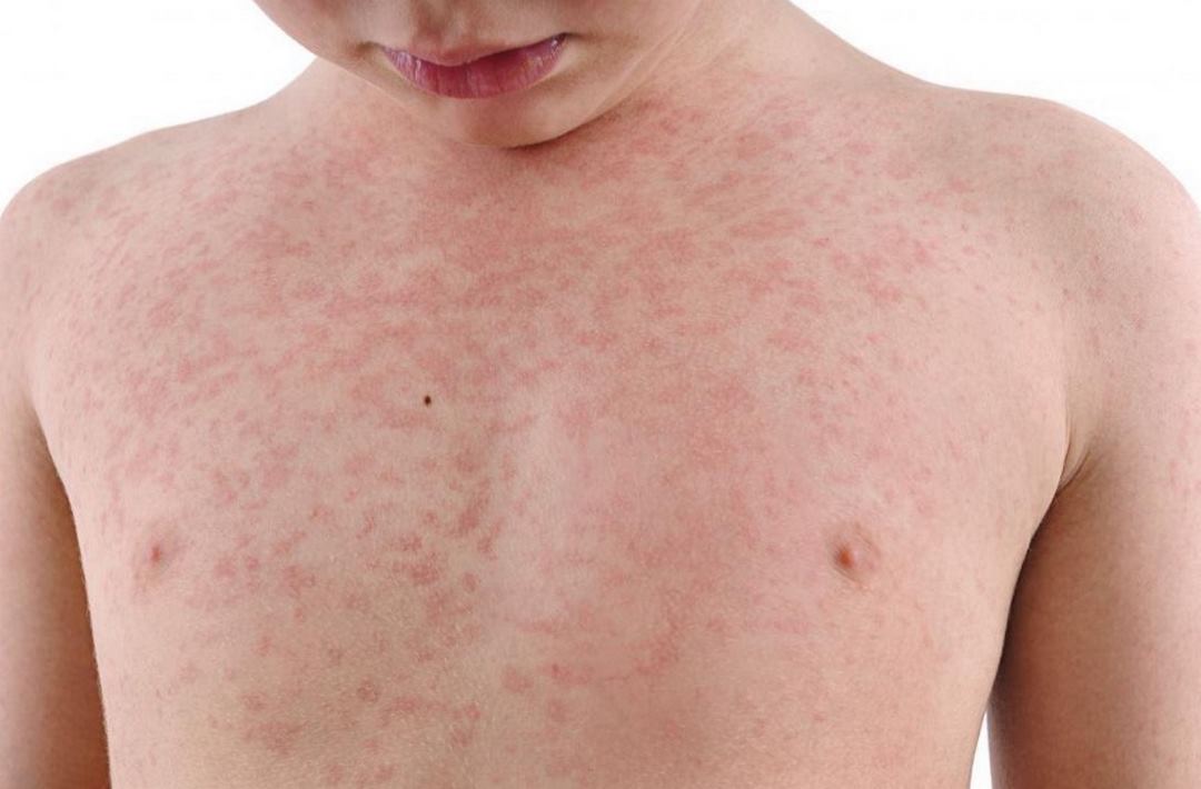 Phân biệt bệnh sởi và rubella