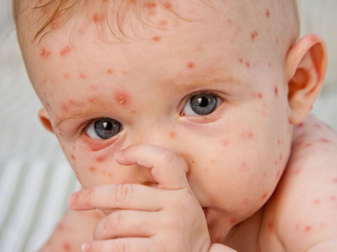 Các nốt phát ban đỏ do virus rubella gây ra