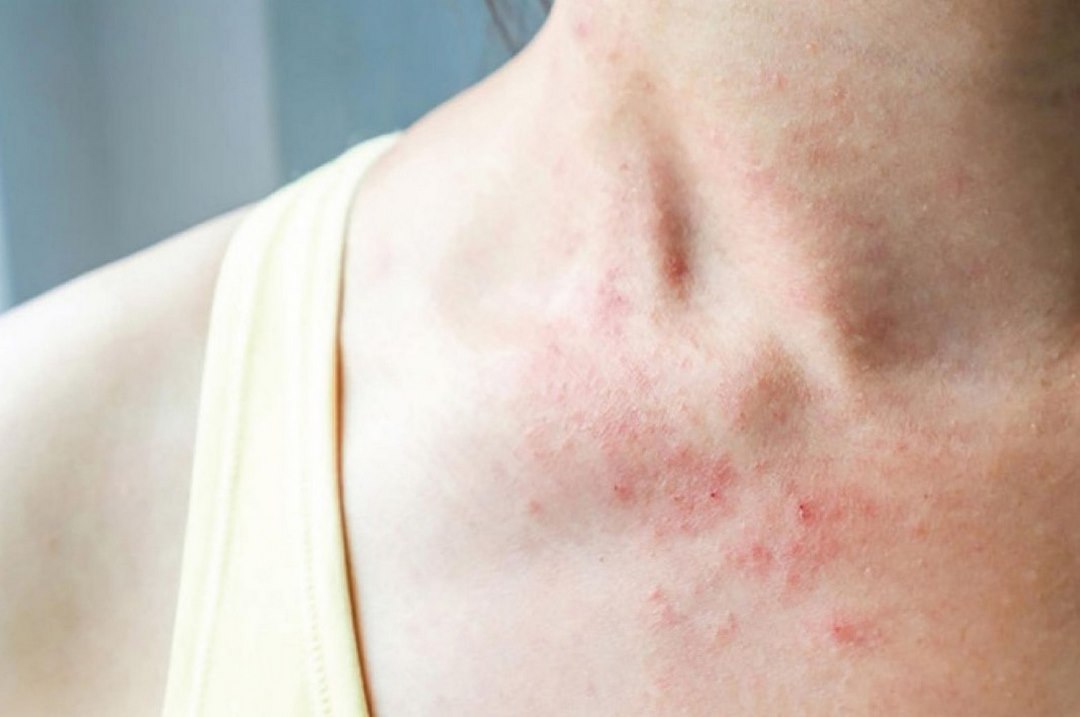 Triệu chứng của sốt phát ban do virus gây ra