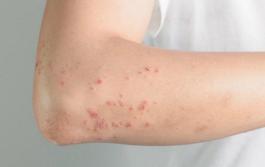 Các nốt phát ban đỏ do virus rubella gây ra (còn gọi là ban đào)