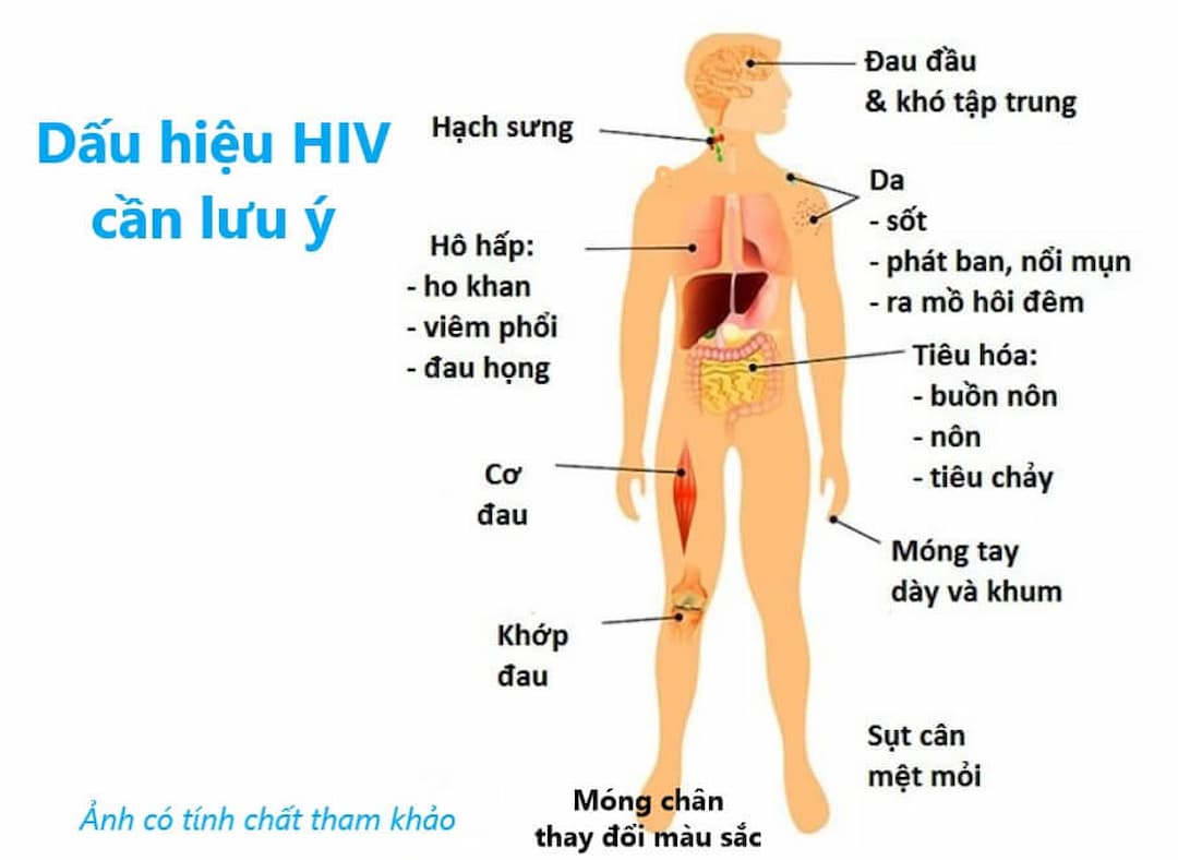 Biểu hiện của HIV/AIDS