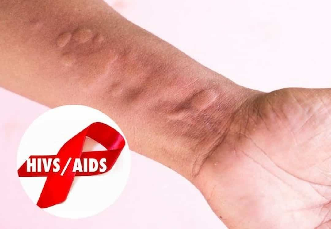 HIV/AIDS có chữa được không